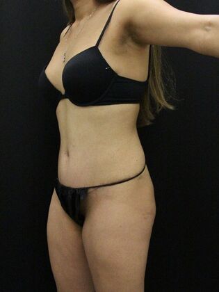 Liposuction: Case 42 - After