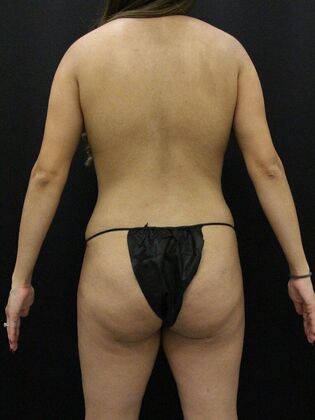 Liposuction: Case 42 - After