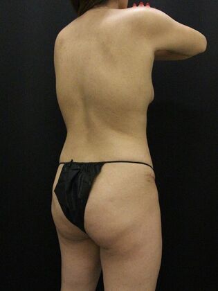 Liposuction: Case 42 - After