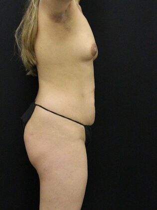 Liposuction: Case 42 - Before