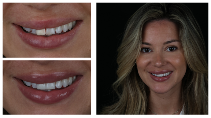 Veneers Case 4