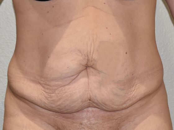Tummy Tuck (Abdominoplasty) Case 532 - Before