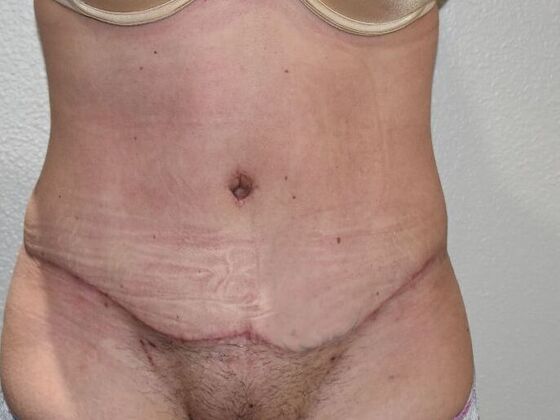 Tummy Tuck (Abdominoplasty) Case 532 - After