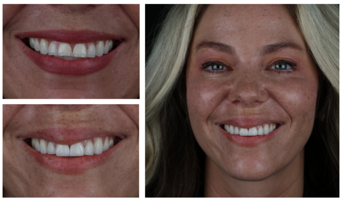 Veneers Case 2