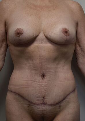 Mommy Makeover Case 338 - After