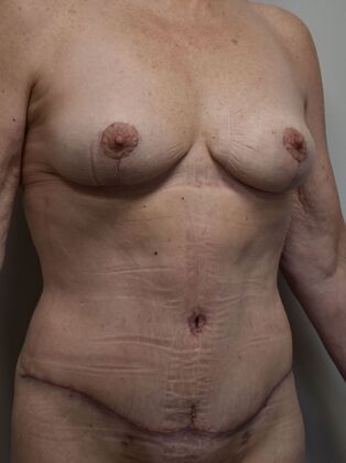 Mommy Makeover: Case 338 - After