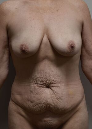 Mommy Makeover Case 338 - Before