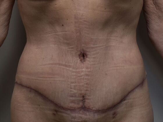 Tummy Tuck (Abdominoplasty) Case 533 - After