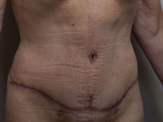 Tummy Tuck (Abdominoplasty): Case 533 - After