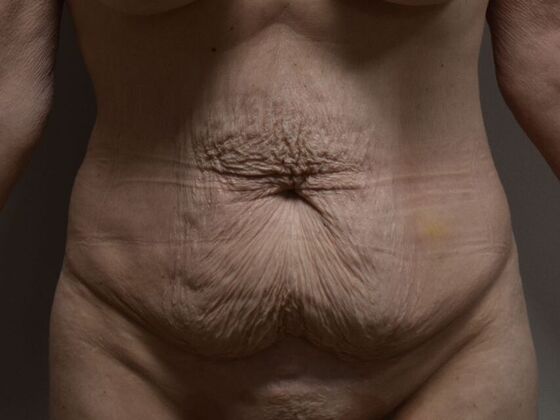 Tummy Tuck (Abdominoplasty) Case 533 - Before
