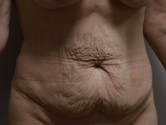 Tummy Tuck (Abdominoplasty): Case 533 - Before