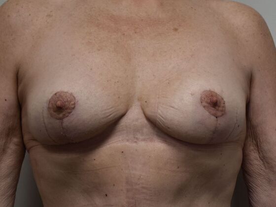 Breast Lift (Mastopexy) Case 241 - After