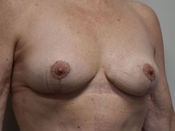 Breast Lift (Mastopexy): Case 241 - After