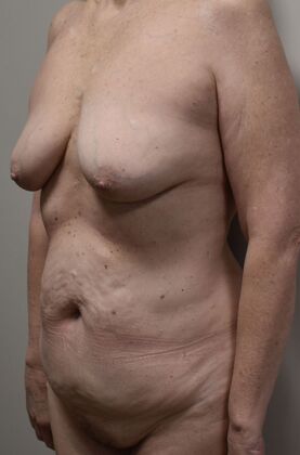 Massive Weight Loss : Case 174 - Before