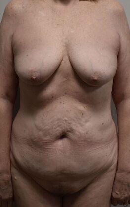 Mommy Makeover Case 339 - Before