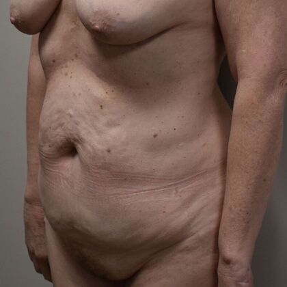 Tummy Tuck (Abdominoplasty): Case 534 - Before