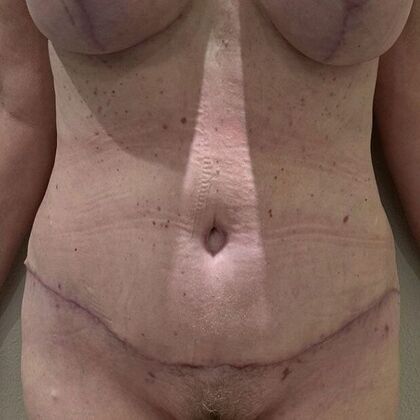Tummy Tuck (Abdominoplasty): Case 534 - After