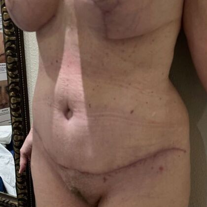 Tummy Tuck (Abdominoplasty): Case 534 - After