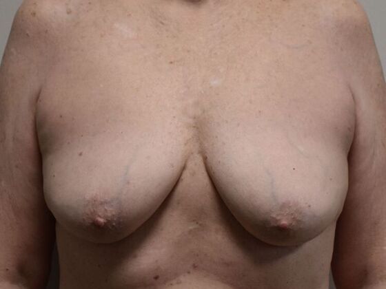 Breast Augmentation w/ Lift Case 592 - Before