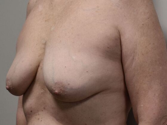 Breast Augmentation w/ Lift: Case 592 - Before