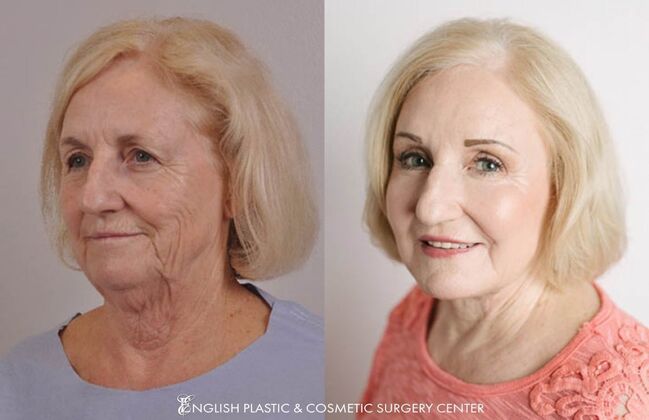 Facial Liposuction: Case 15 - Before & After