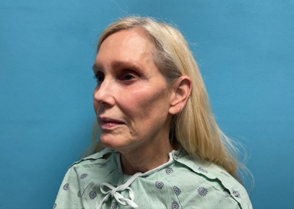 Facelift: Case 8 - Before