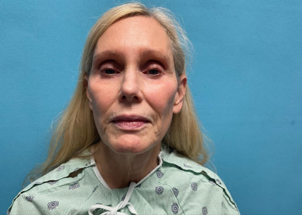 Facelift Case 8 - Before