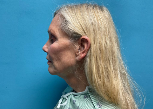 Facelift: Case 8 - Before