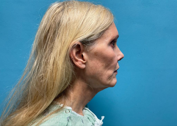 Facelift: Case 8 - Before