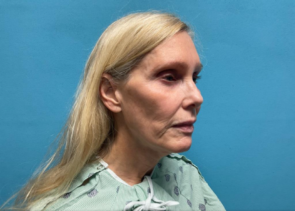 Facelift: Case 8 - Before