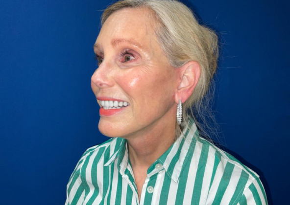 Facelift: Case 8 - After