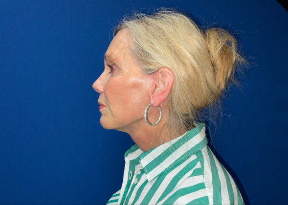 Facelift: Case 8 - After