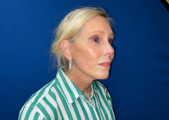 Facelift: Case 8 - After