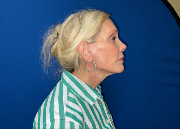 Facelift: Case 8 - After