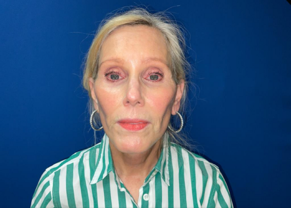 Facelift Case 8 - After