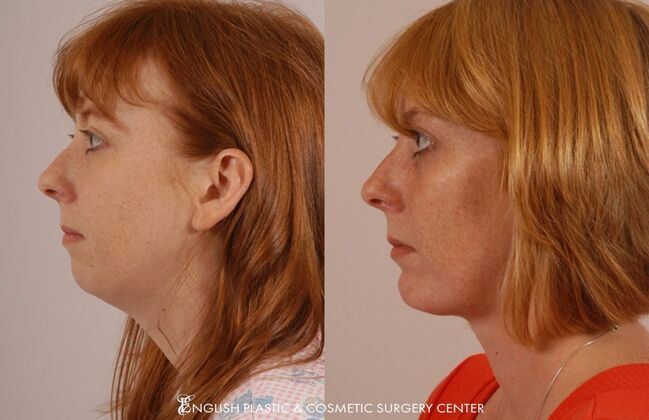 Facial Liposuction: Case 31 - Before & After