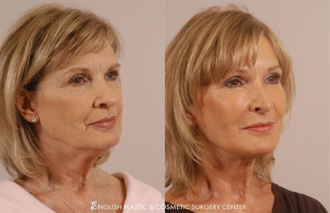 Facial Liposuction: Case 28 - Before & After