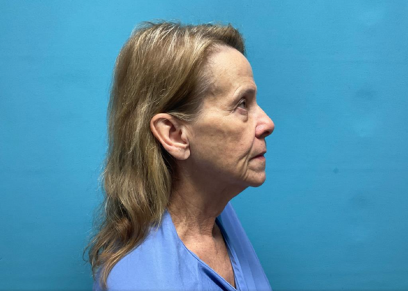 Facelift: Case 7 - Before