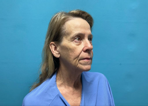 Facelift: Case 7 - Before