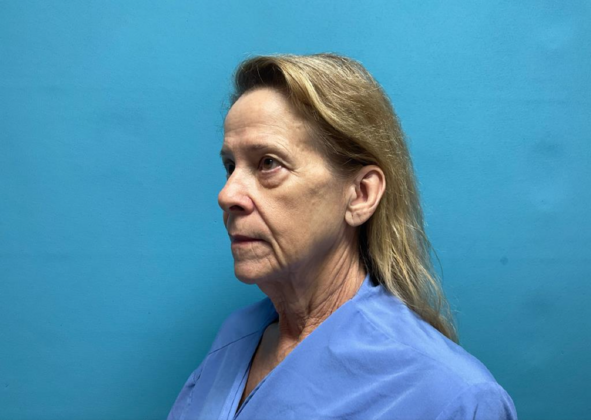 Facelift: Case 7 - Before