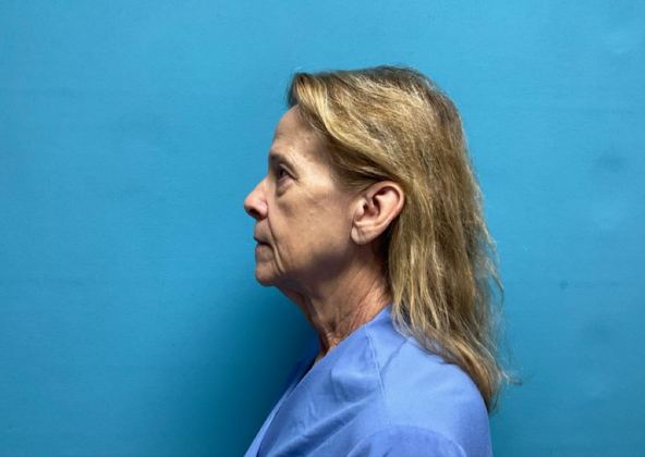 Facelift: Case 7 - Before