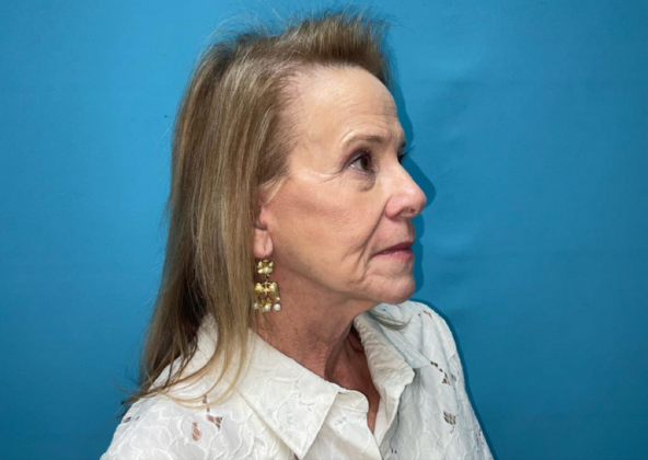 Facelift: Case 7 - After