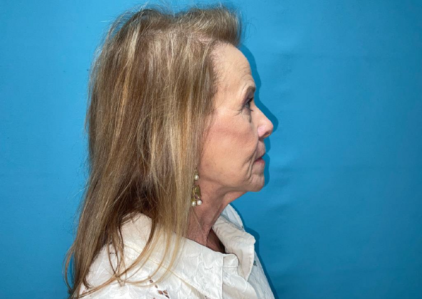 Facelift: Case 7 - After