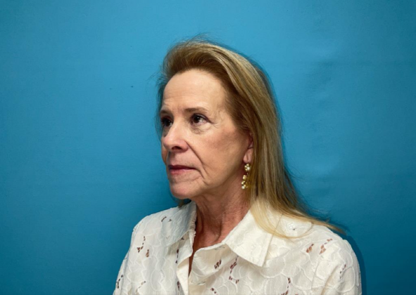 Facelift: Case 7 - After