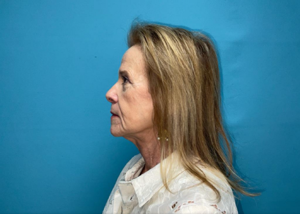 Facelift: Case 7 - After