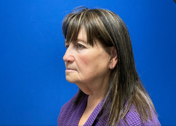 Facelift: Case 4 - Before