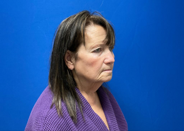 Facelift: Case 4 - Before