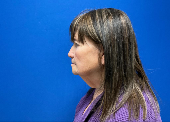 Facelift: Case 4 - Before