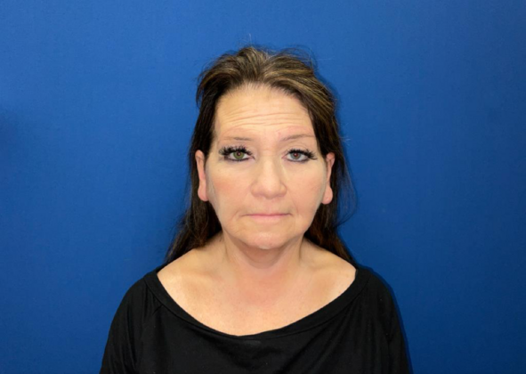 Facelift Case 4 - After