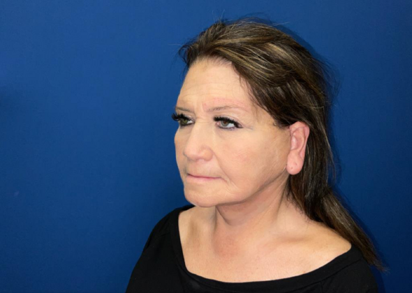 Facelift: Case 4 - After